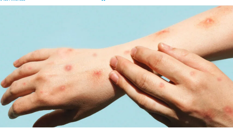 En La Paz intensifican vigilancia epidemiológica en aeropuerto ante alerta por viruela símica 