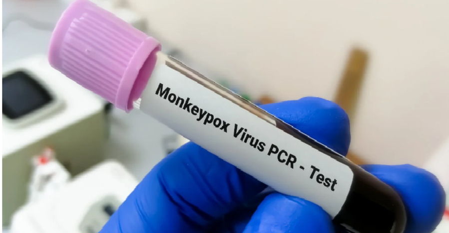 Descartan caso sospechoso de viruela del mono tras pruebas de laboratorio