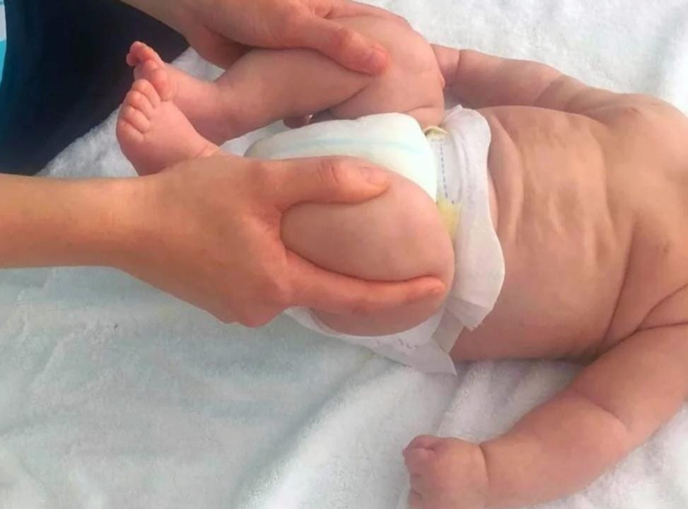 Lanzan campaña gratuita de detección de displasia de cadera para niños hasta un año en La Paz