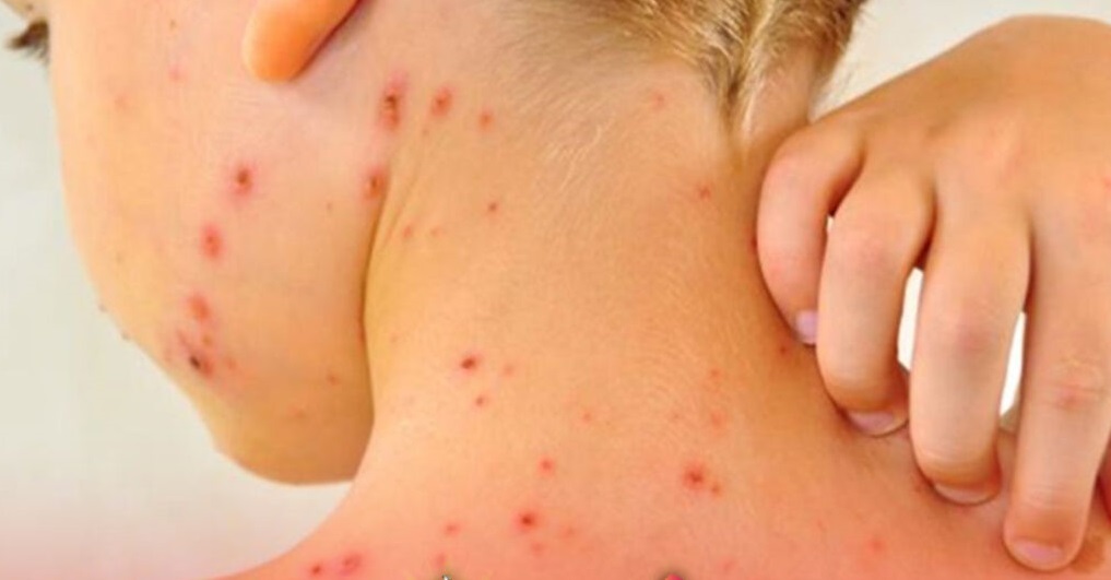 Reportan un caso de sarampión en Viacha, más de 100 brigadas se movilizan para el bloqueo vacunal en el municipio