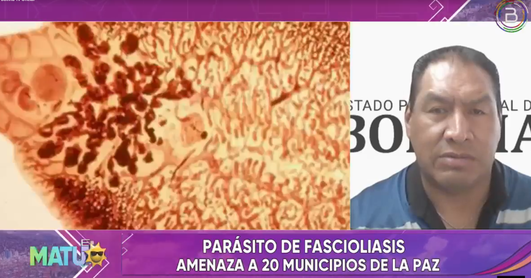 Fallece una niña de 5 años por Fascioliasis en Sorata