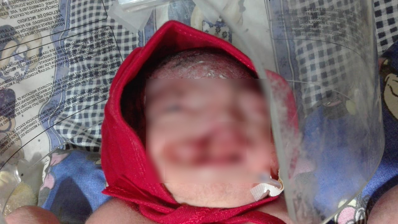 Recién nacido con labio leporino extremo salva su vida gracias al SUS