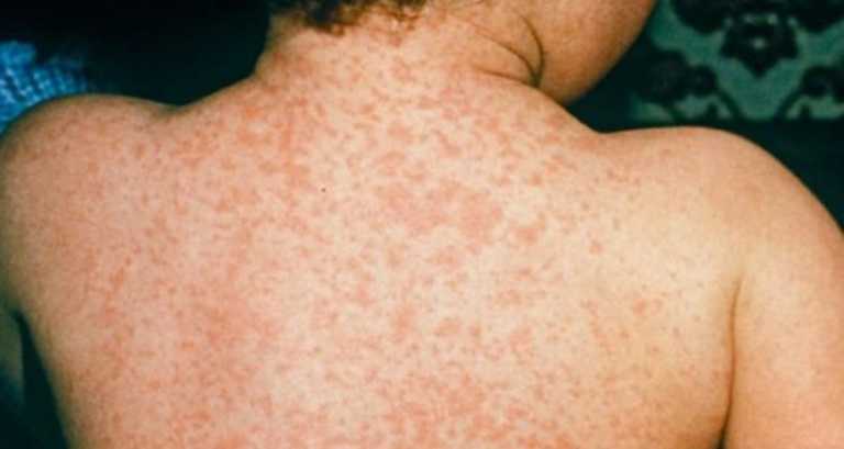 Confirman casos de sarampión en tres regiones del continente americano